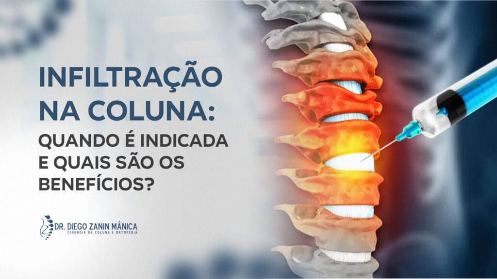 Infiltração na coluna: quando é indicada e quais são os benefícios?