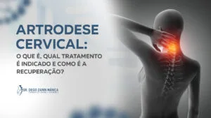 Artrodese Cervical: tratamento e recuperação em Pres. Prudente