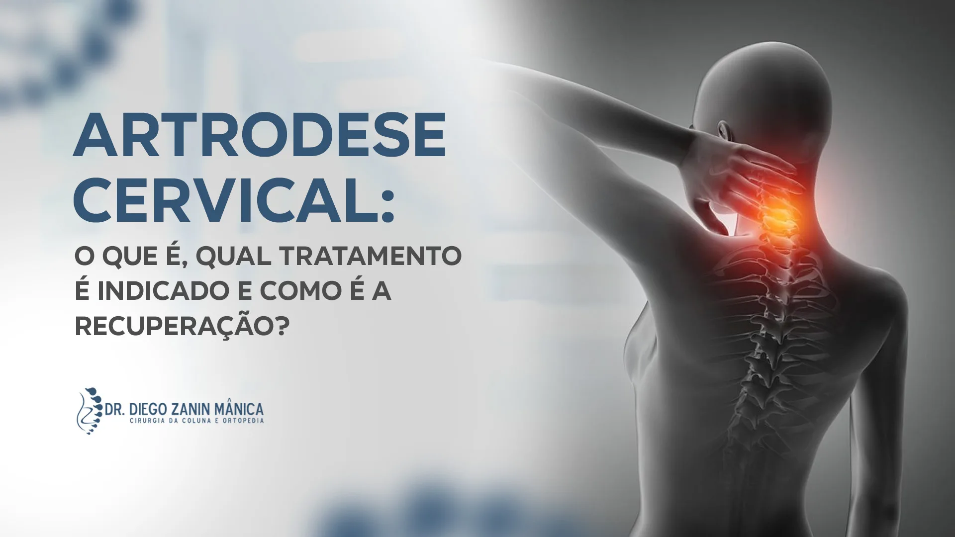 Artrodese Cervical: tratamento e recuperação em Pres. Prudente